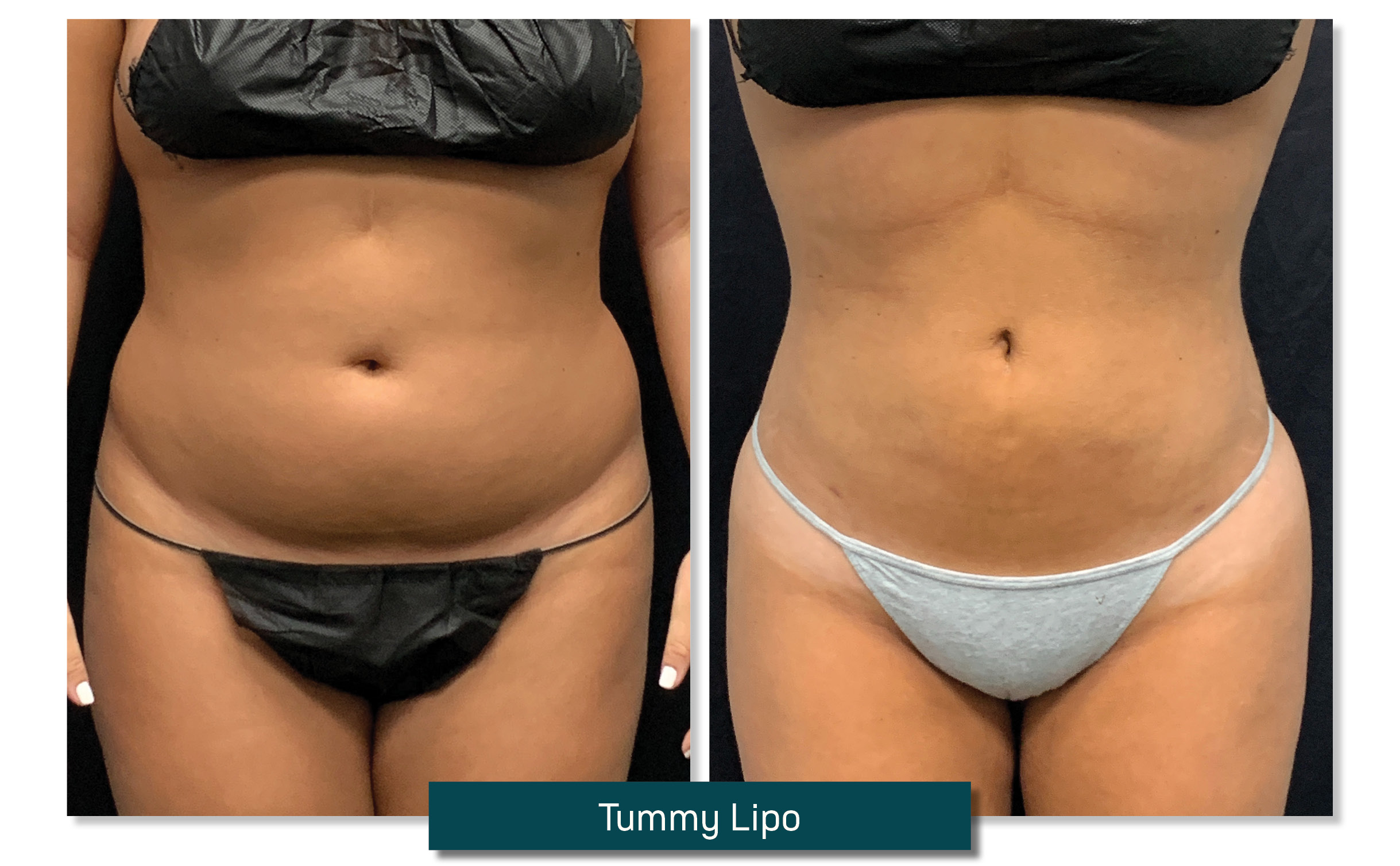 tummy lipo - before and after