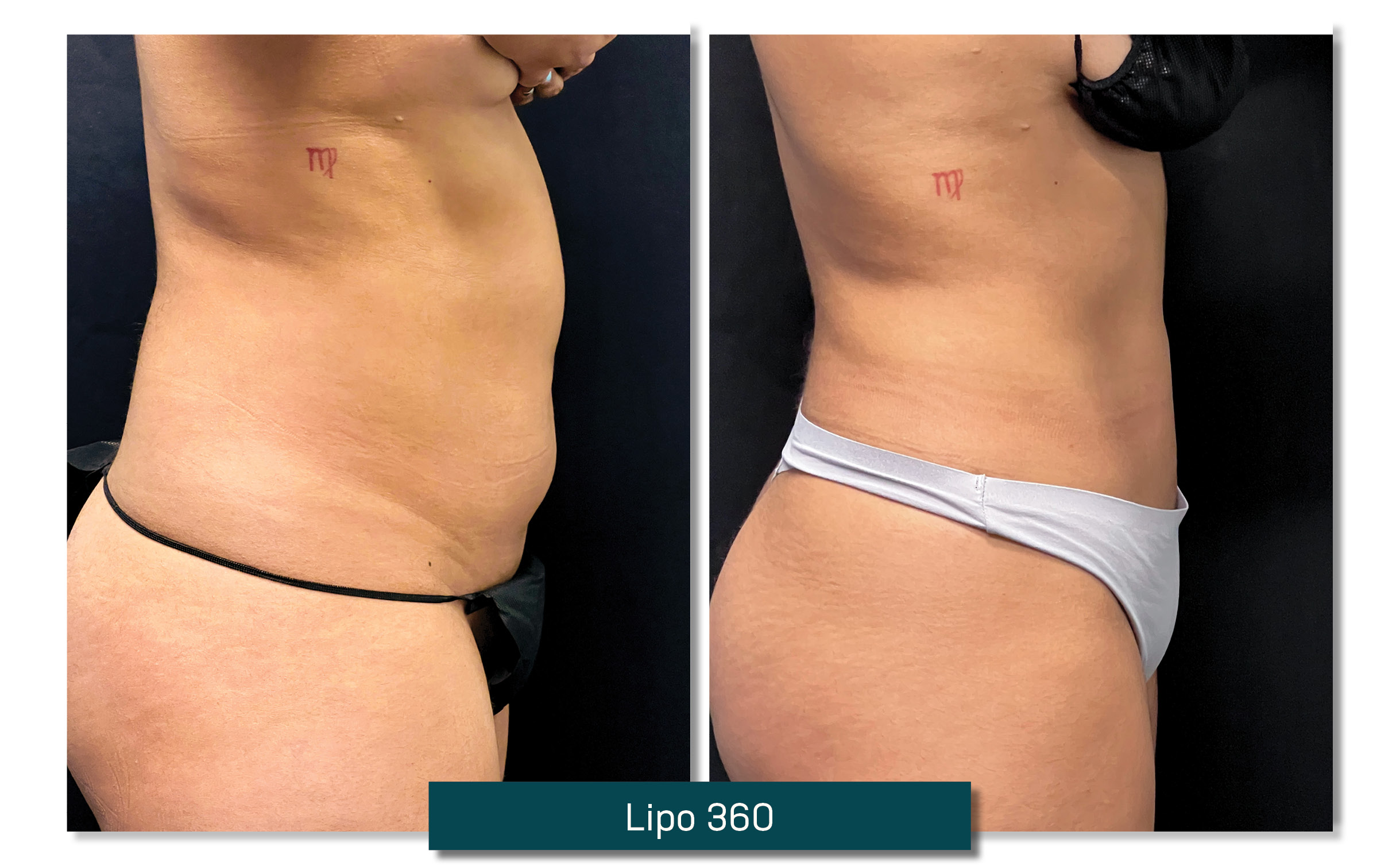 lipo 360 - before and after