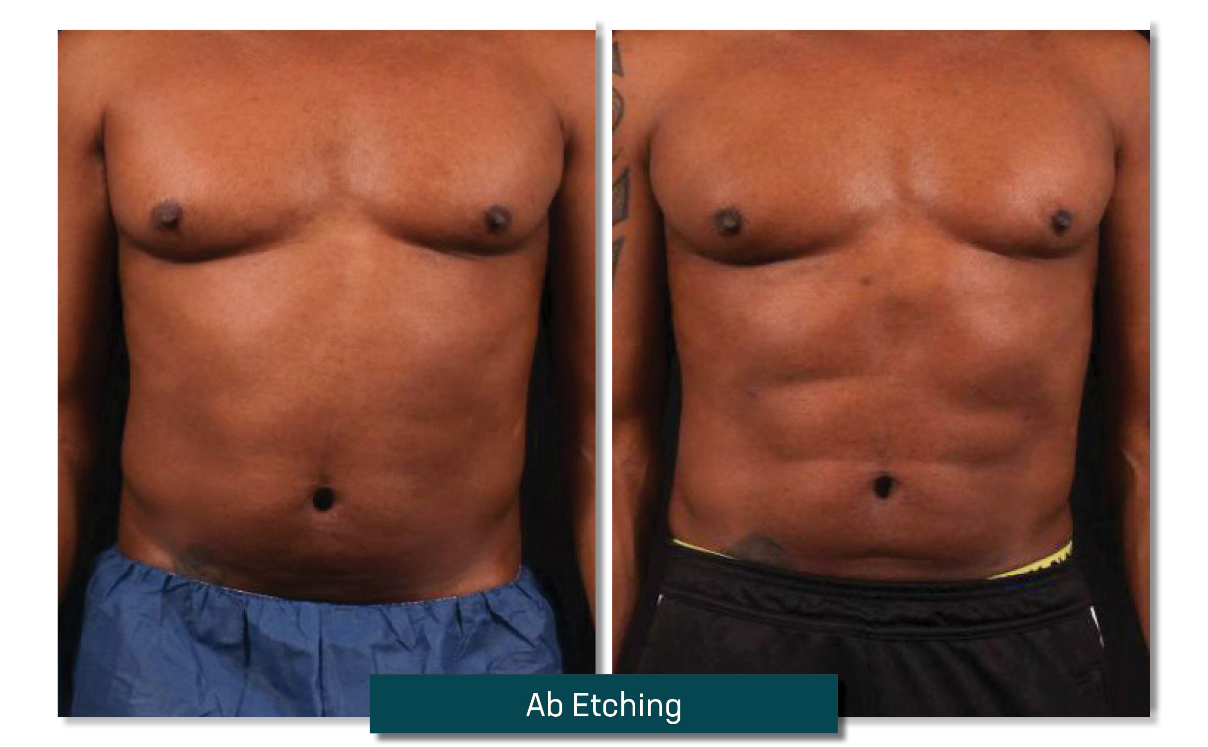 ab etching - before and after