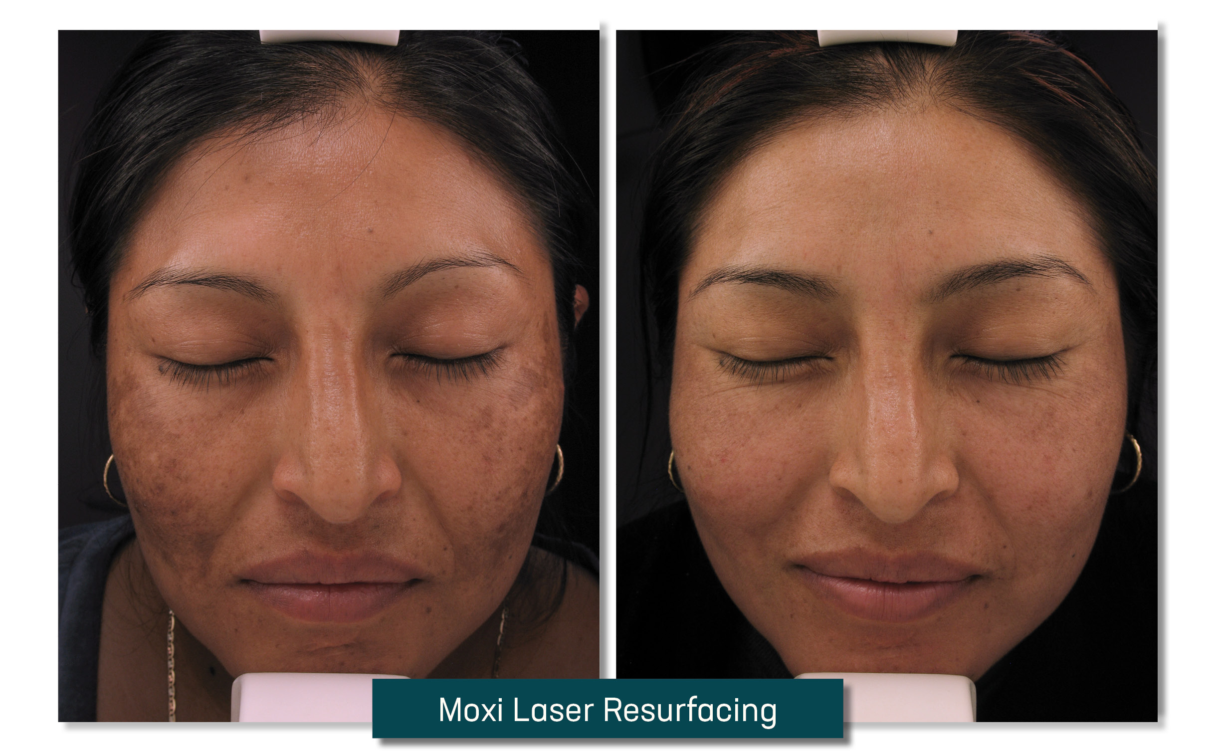 laser resurfacing - before and after