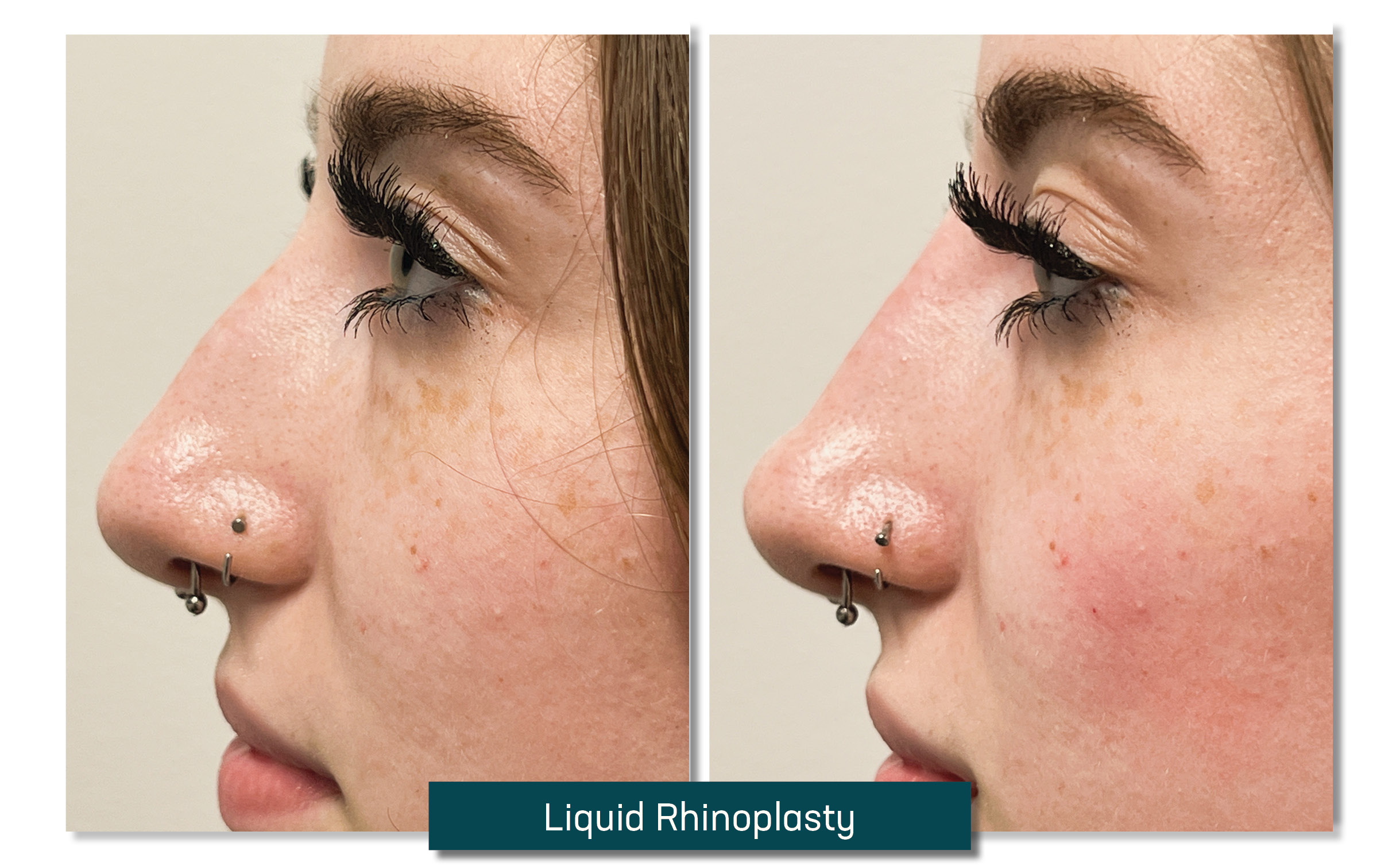 liquid rhinoplasty - before and after
