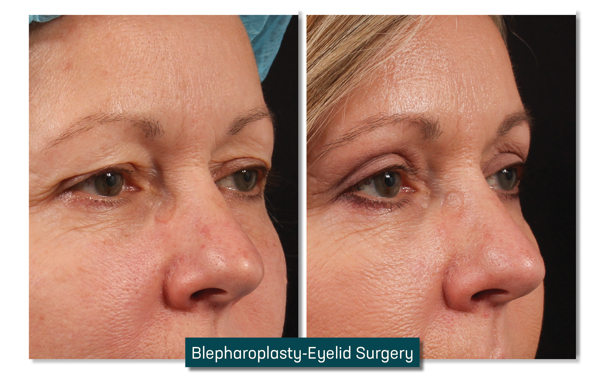 eyelid surgery - before and after