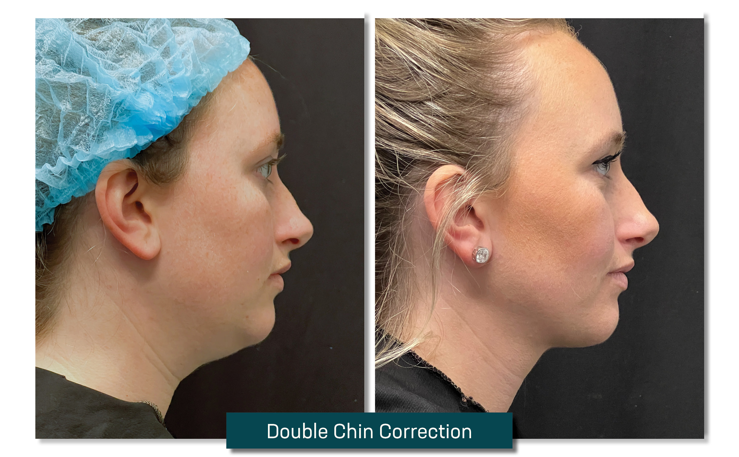double chin correction - before and after