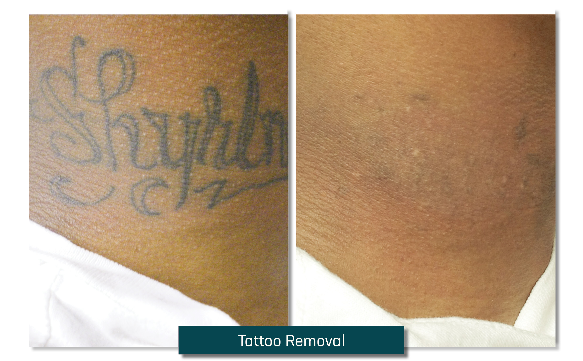 tatoo removal - before and after