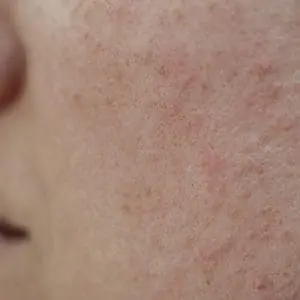 rosacea
