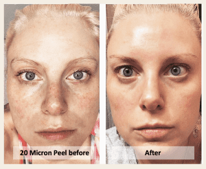 Micro Laser Peel Skin treatment