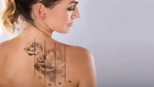 laser tattoo removal