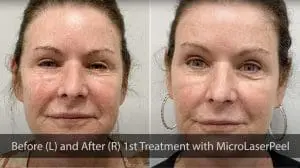 Before and After Photos MicroLaserPeel for Rejuvenated Skin by Profile MD in Maryland