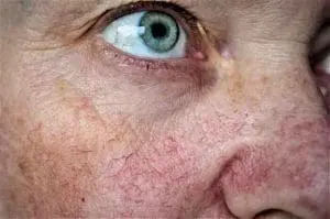 rosacea 1