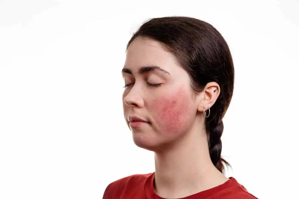 Profile MD offers Rosacea Treatments in Maryland