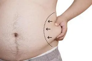 liposuction