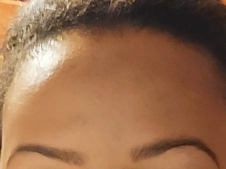 After Results of Post-Inflammatory Hyperpigmentation Treatment at Profile MD