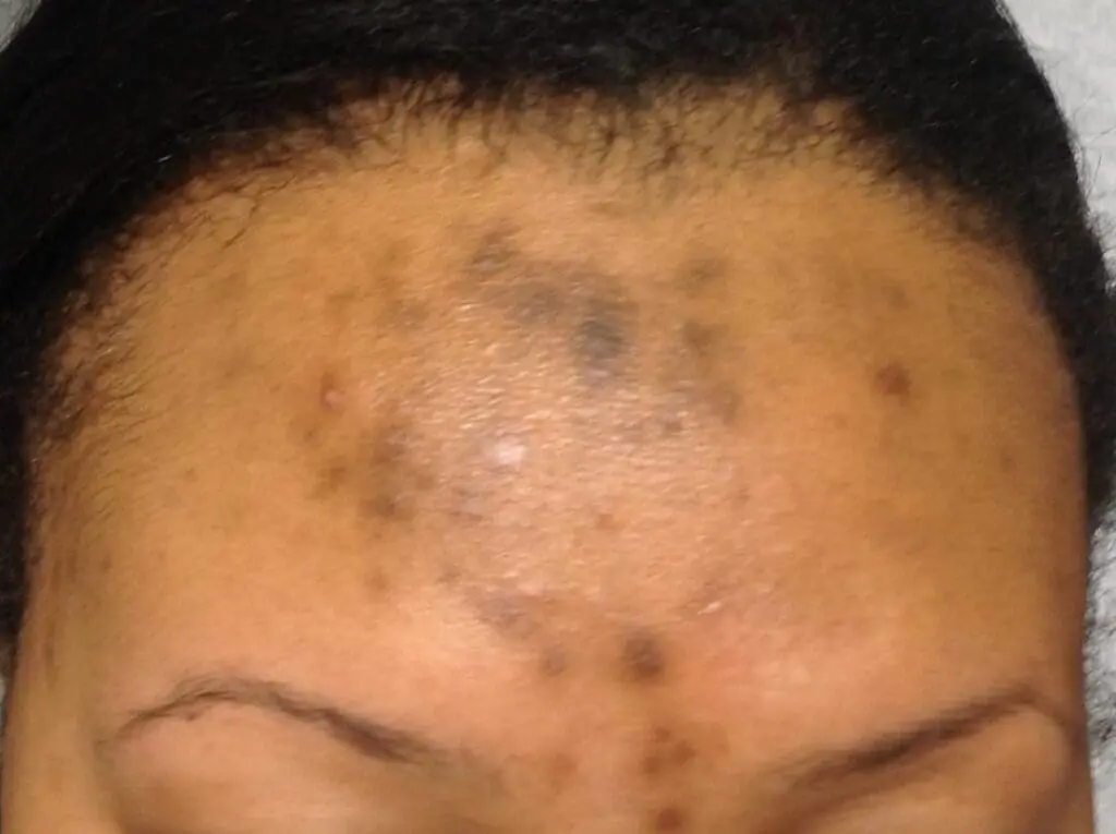 Before treatment for Post-Inflammatory Hyperpigmentation at Profile MD