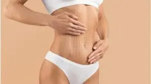 Profile MD of Maryland specializes in Treating Unsightly Tummy Tuck Scars