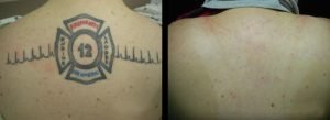 Image of a persons back with an EMT symbol tattoo next to an image of the persons back after the tattoo is removed.