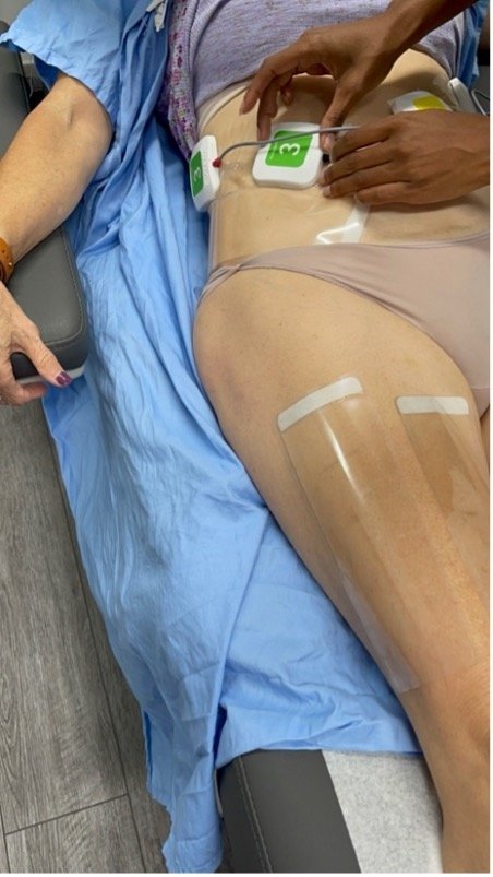 application of the truSculpt Flex pads on the abdomen