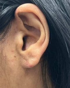 Keloid After Ear Piercing - Profile MD
