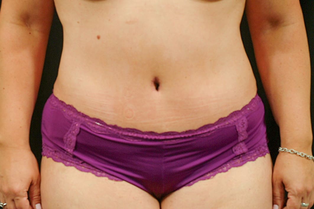 Tummy Tuck Profile MD