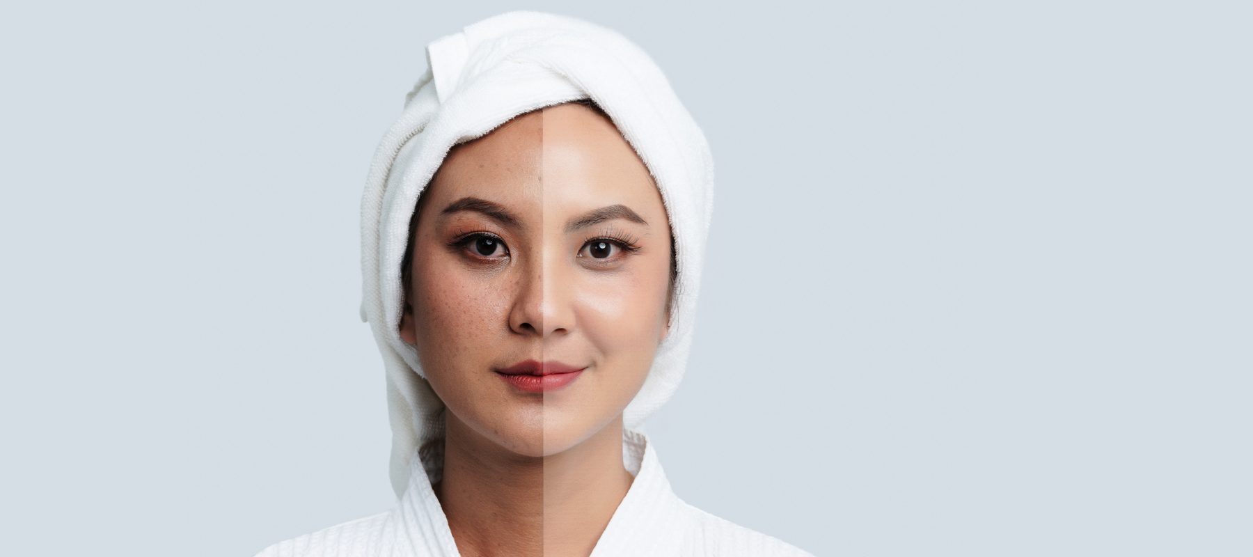 Hyperpigmentation Laser Treatments in Maryland