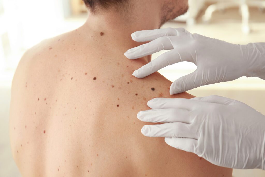 Dermatologist examining patient's moles.